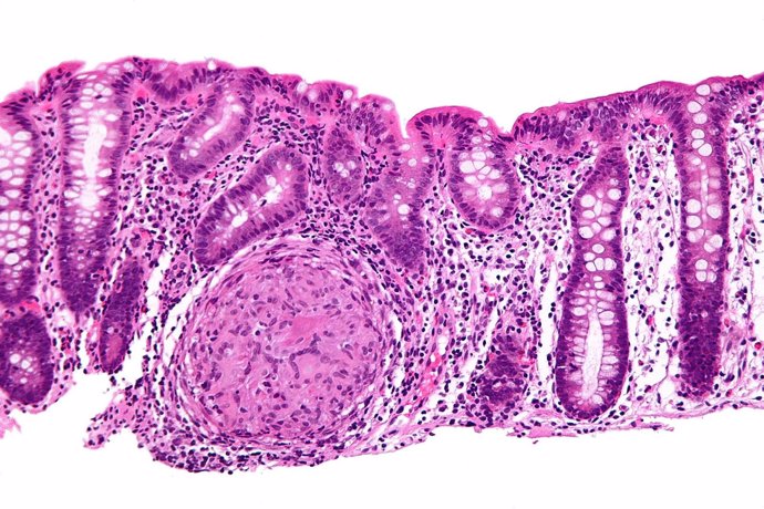 Biopsia endoscópica donde se puede apreciar inflamación granulomatosa del colon 
