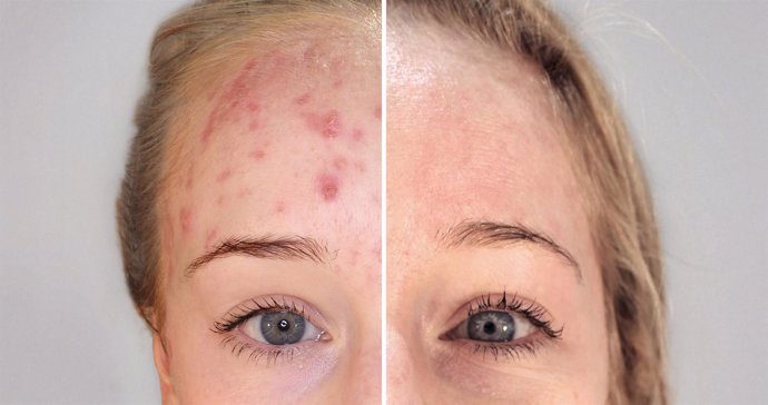 Terapia biofotónica para el tratamiento del acné en la mujer madura