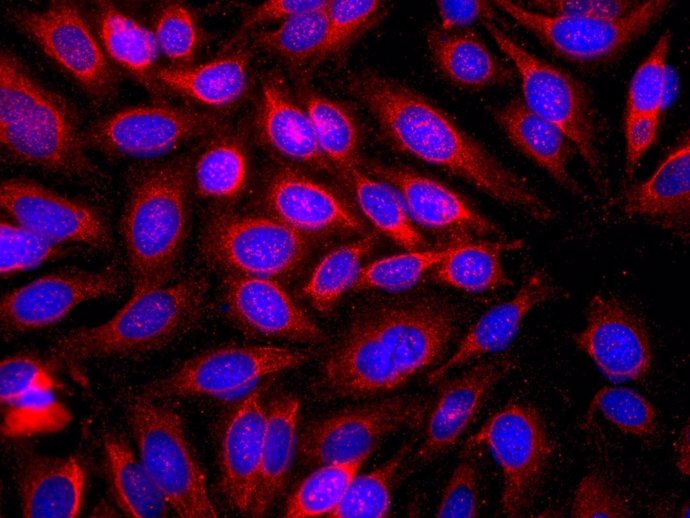 Células de cáncer de piel humano (azul) con anticuerpo IgE Unido a ellas (rojo).