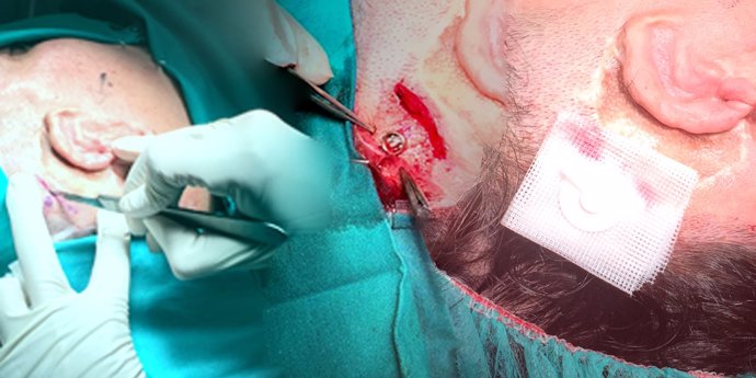 Proceso quirúrgico para realizar el implante de la prótesis de titanio