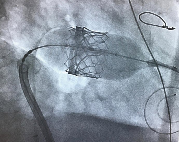 Valvula mitral técnica que evita operación a corazón abierto