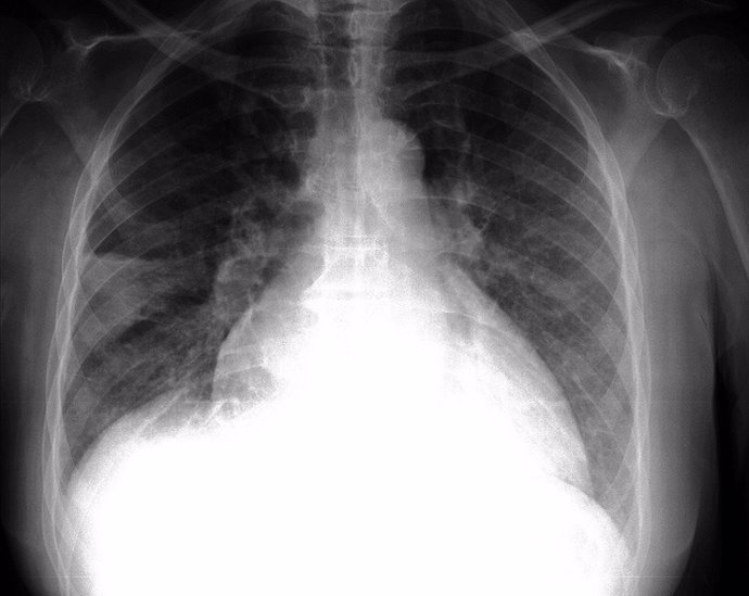 Patología pulmonar