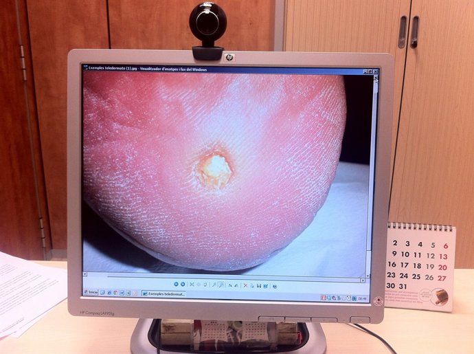 Imatge utilitzada en el model de teledermatologia