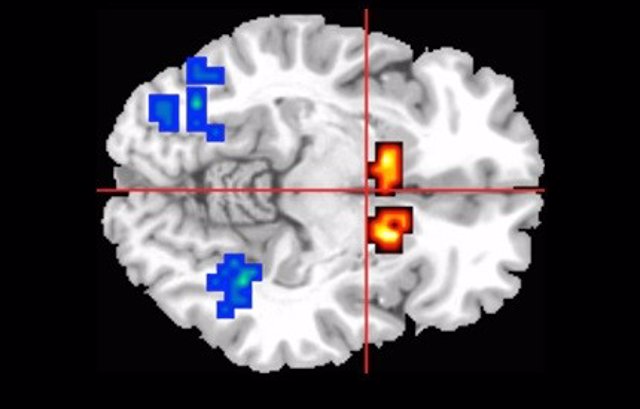 Áreas Afectadas Del Cerebro En Personas Con Psicosis