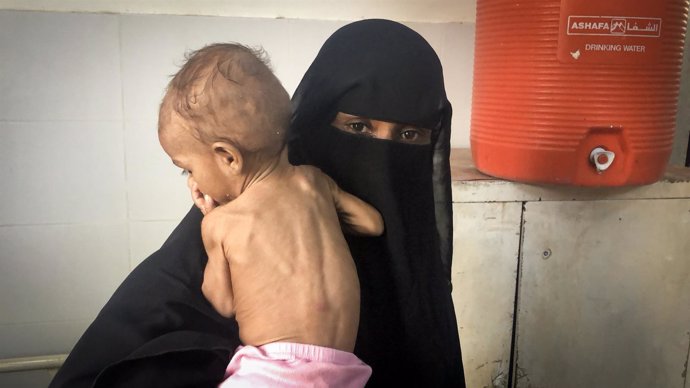 Niño con desnutrición en Yemen