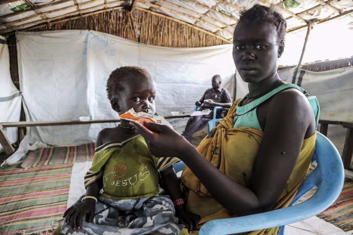Niño con desnutrición en Sudán del Sur