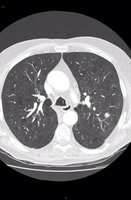 Deteccion precoz del cáncer de pulmón. 