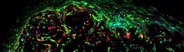 Células cancerosas 'pintadas' por el ISCIII para entender un tumor