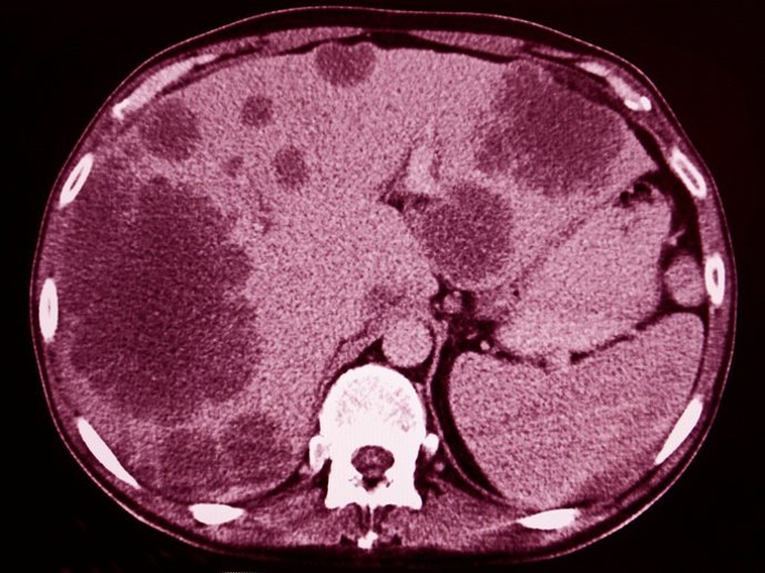 Metastasis