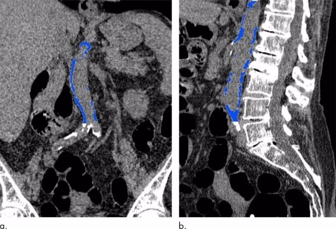 La calcificación aórtica abdominal puede indicar un ataque cardiaco futuro