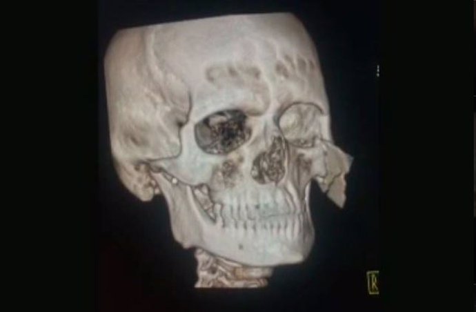 Radiografía del afectado con el disco de la pulidora incrustado