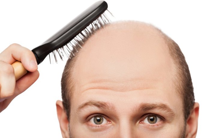 Calvo, calvicie, alopecia