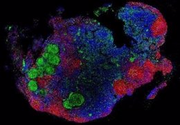 Un ganglio linfático infectado de la bacteria de la tuberculosis