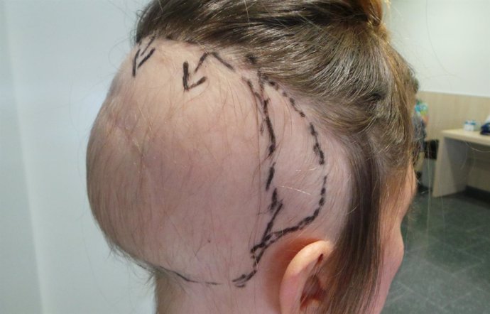 Tecnica del sistema capilar fijo. Alopecia