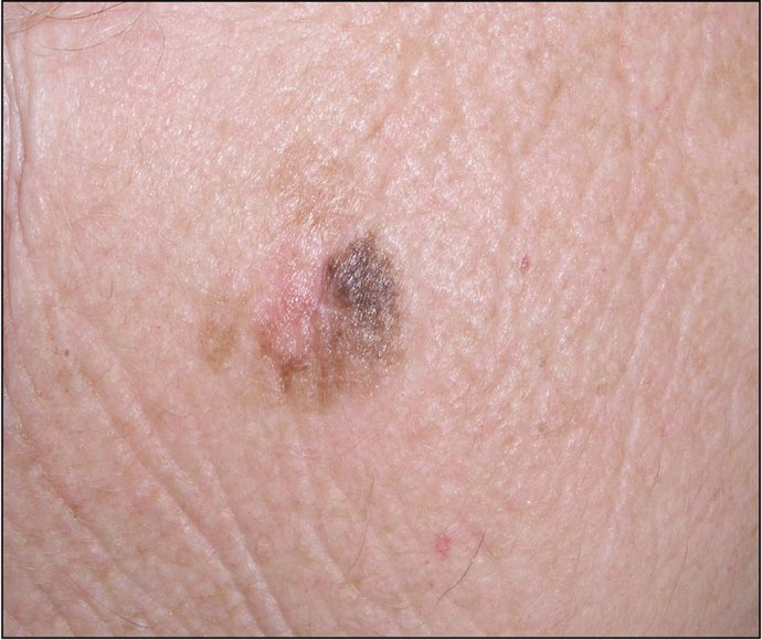 Melanoma
