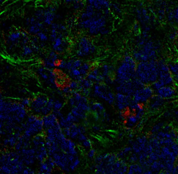Tumor de mama de ratón con fibroblastos derivados de la médula ósea