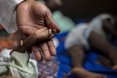 Una niña con desnutrición aguda severa en RCA