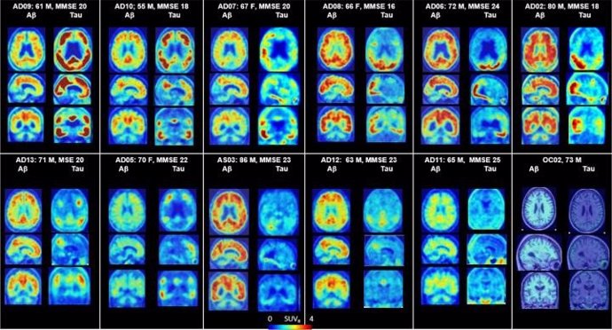 PET del cerebro que muestra placas amiloides y proteínas tau en Alzheimer