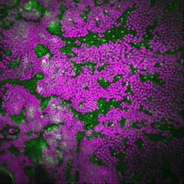 Expansión de células tumorales (púrpura) y deformación de células vecinas (verde