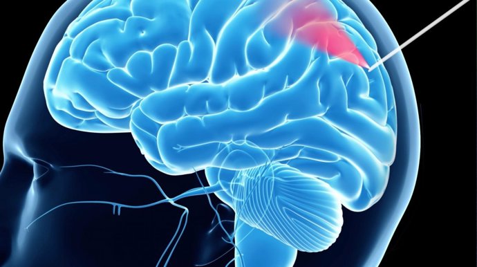 Aguja de biopsia que hace más segura la cirugía cerebral