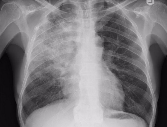 Neumonía, pulmonía, radiografía pulmones