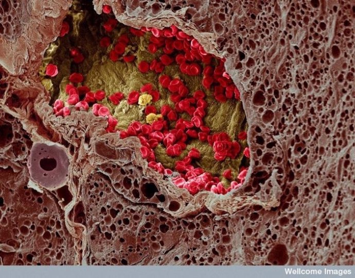 Imagen a microscopio electrónico de un cáncer de piel con melanoma