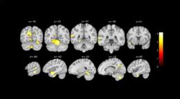 Cambios en el cerebro detectados por el estudio de la Fundación Pasqual Maragall