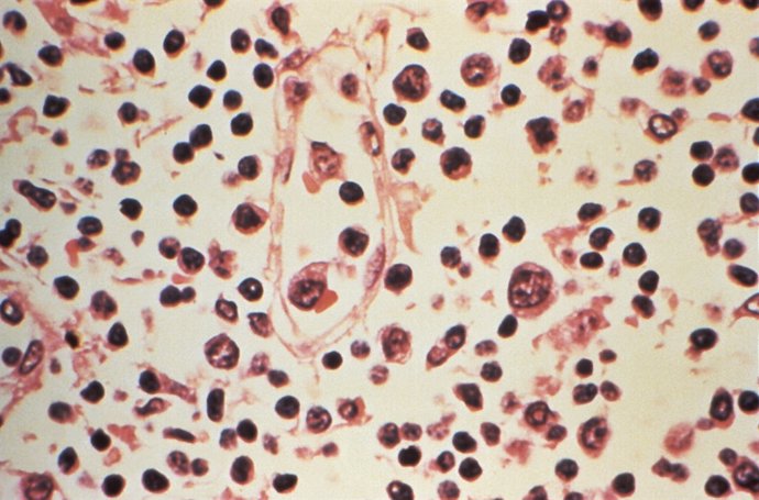 Some of the cytoarchitectural features in a lymph node specimen extracted from a