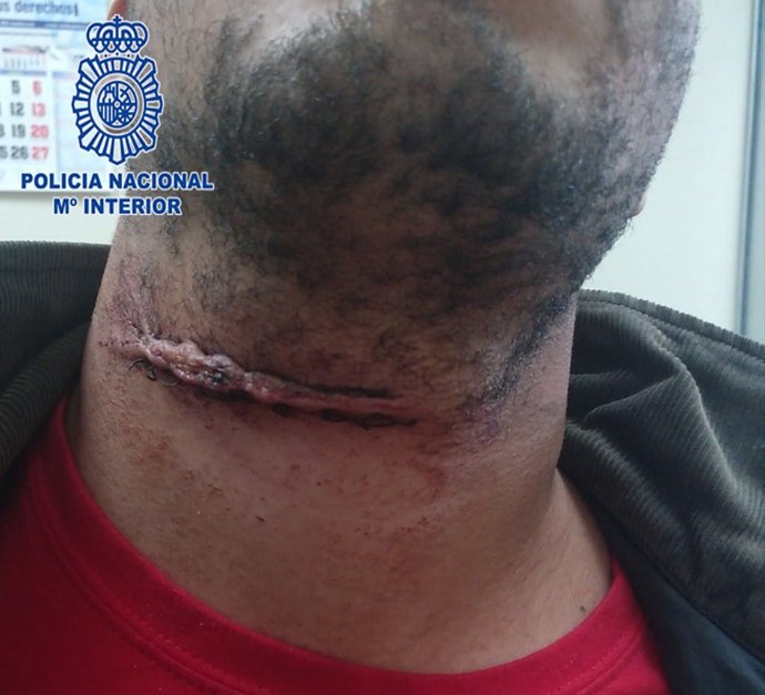 Imagen de las lesiones sufridas en el cuello