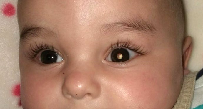 Un dels pacients afectat per un retinoblastoma amb leucocoria