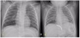 Foto: Tratan con éxito un secuestro pulmonar mediante embolización como alternativa a la cirugía clásica
