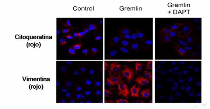 La proteína 'Gremlin', que podría promover la fibrosis renal