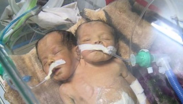 Resultado de imagen de mueren niños yemenies