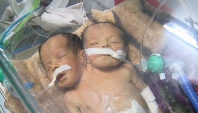 Niños yemeníes unidos por el torso