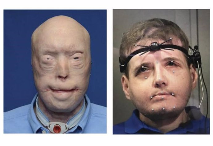 Patrick Hardison, un hombre estadounidense al que se trasplantó la cara tras un 