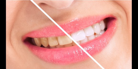 1. ¿Por qué se amarillean los dientes? ¿Se puede evitar?