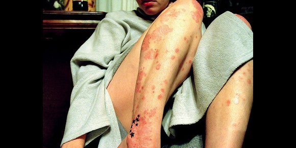 9. Un nuevo programa interactivo facilita la detección precoz de la artritis psoriásica