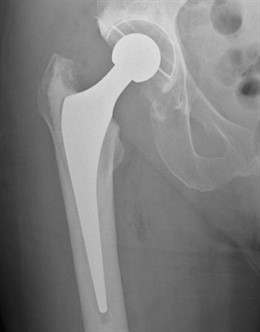 Radiografía de reemplazo de cadera