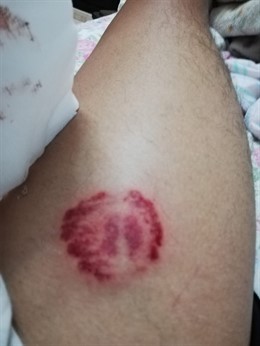 Mordedura denunciada por el árbitro