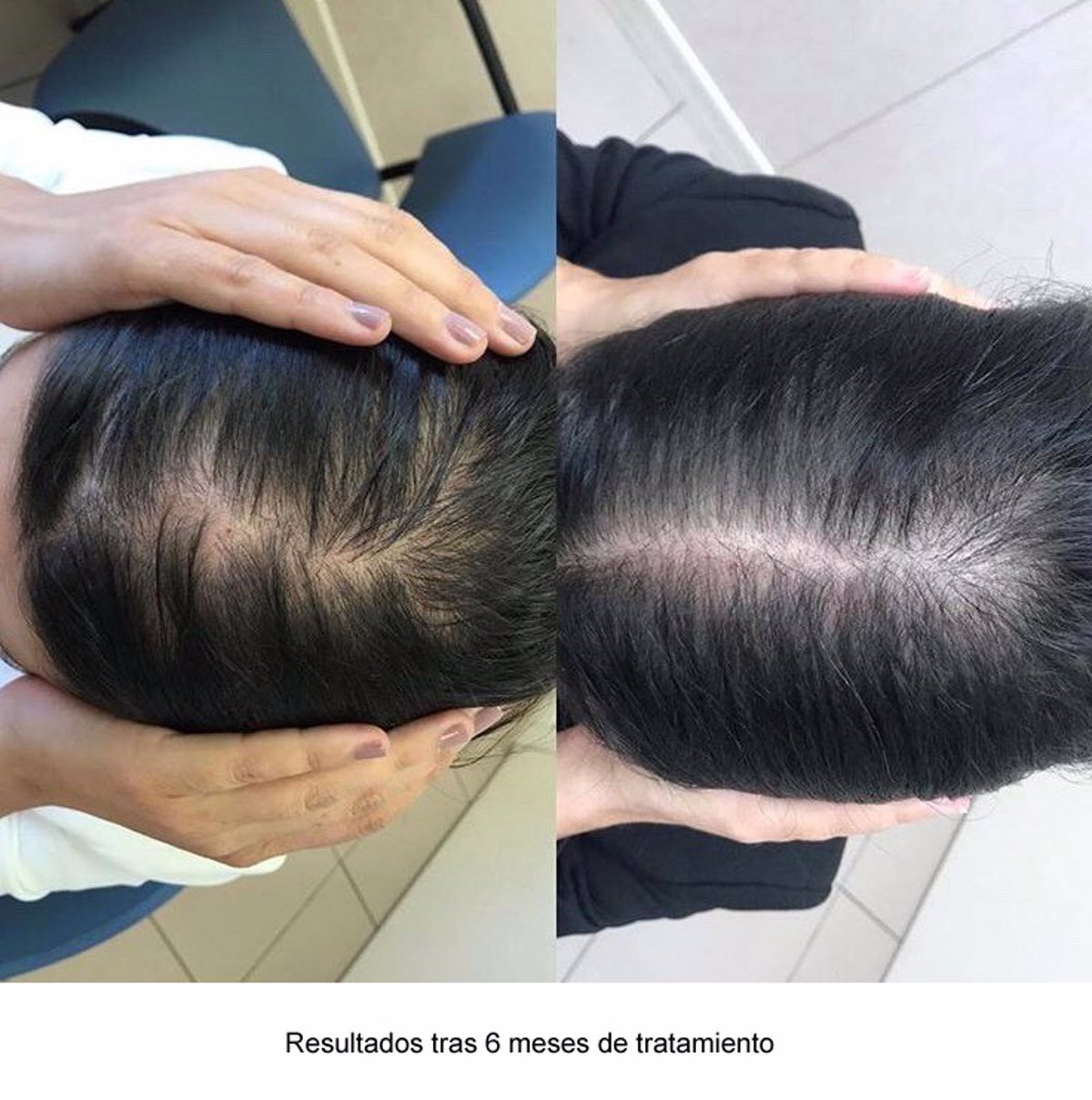 La consulta de tricología H. Quirónsalud San José una nueva para la alopecia androgenética