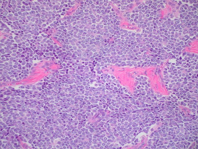 Sarcoma de Ewing