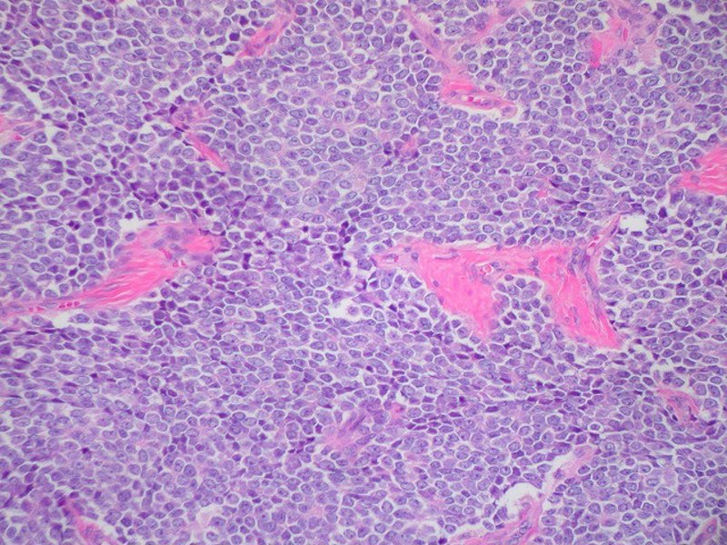 El Sarcoma De Tejidos Blandos Requiere Un Abordaje Multidisciplinar ...