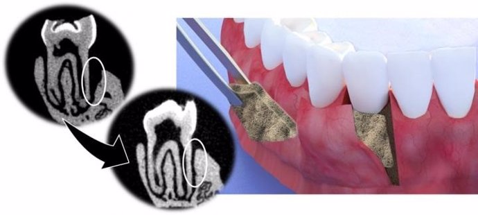 EEUU.- Investigadores crean una membrana que ayuda a regenerar tejido periodonta