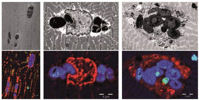Identifican una nueva enfermedad muscular causada por una mutación en genética