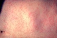 El sarampión regresa a Uruguay tras 20 años erradicado en el país