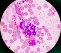 Visualizan por primera vez cómo luchan las células CAR-T contra un cáncer de san