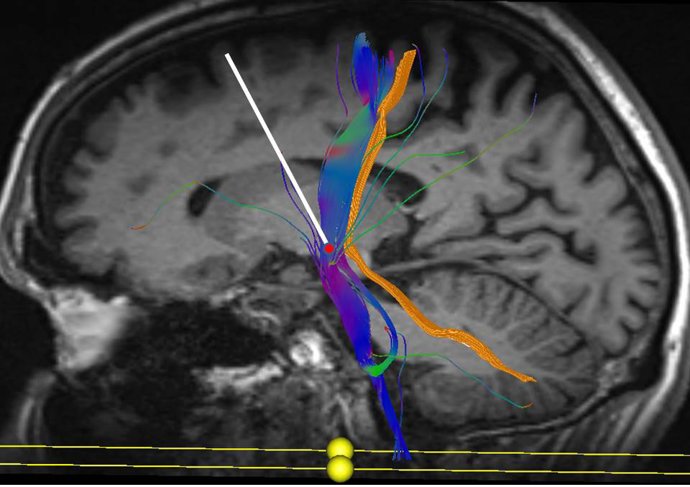 El HUCA amplía técnicas de cirugía para el tratamiento de los pacientes con párk