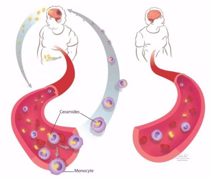 El índice de masa corporal afecta al empeoramiento de la esclerosis múltiple, según un estudio