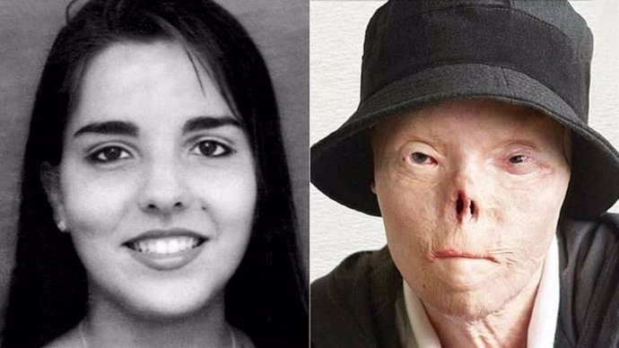La valiente historia de la venezolana Jacqueline Saburido, la mujer que se quedó sin rostro por un conductor ebrio