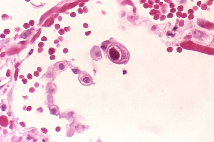 La infección por citomegalovirus amplía el espectro de alérgenos ambientales